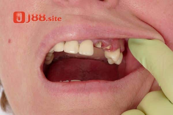Giải thích hiện tượng mơ thấy người yêu bị rụng răng không chảy máu Giải thích hiện tượng mơ thấy người yêu bị rụng răng không chảy máu